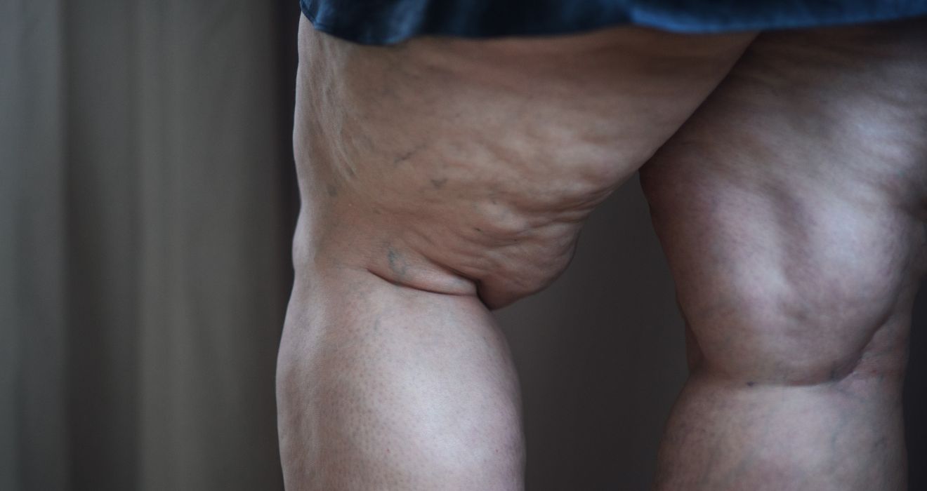 proceso de la cirugía de lipedema en piernas