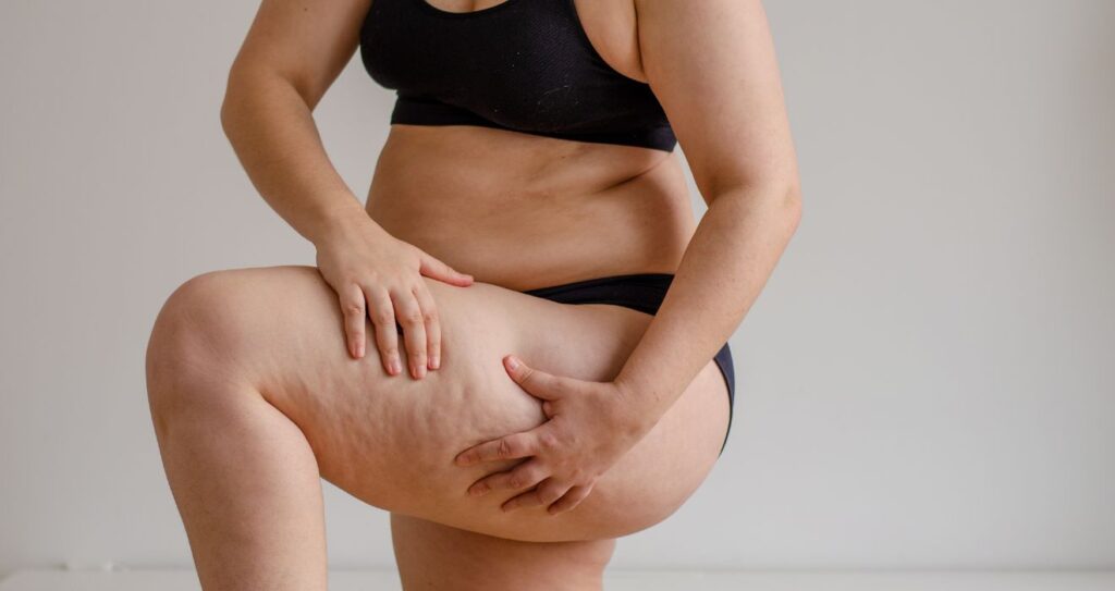 postoperatorio y resultados del lipedema en piernas