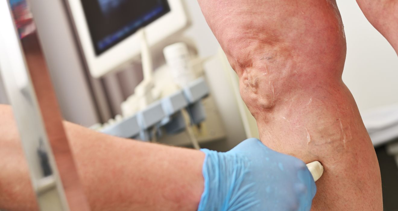 revisión de la cirugía de lipedema en piernas